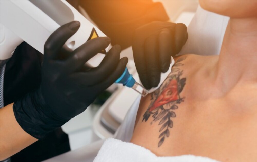 Tattoo Removal - dark ink tattoo studio
